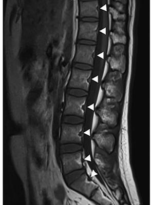 Morphological features of basivertebral foramen among different age groups: Recognition in spine